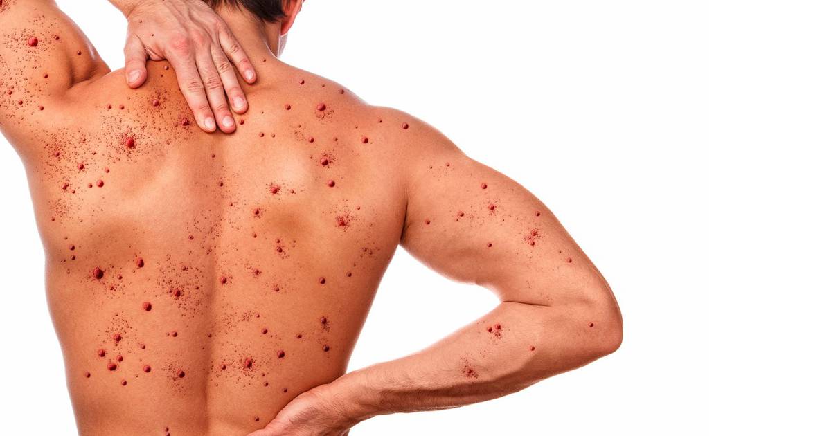 Otra semana sin casos de viruela del mono: 10 sospechosos, descartados